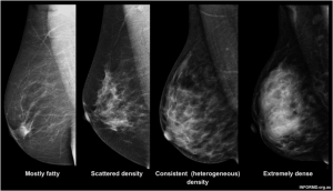 AI may help doctors identify hidden risk factors for breast cancer